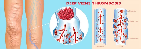 Trombose de Veia Profunda ou Fendas de Sangue. Embolus . — Fotografia de Stock