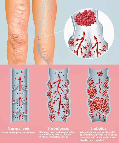 Deep Vein Thrombosis or Blood Clots. Embolus. — Stock Photo, Image