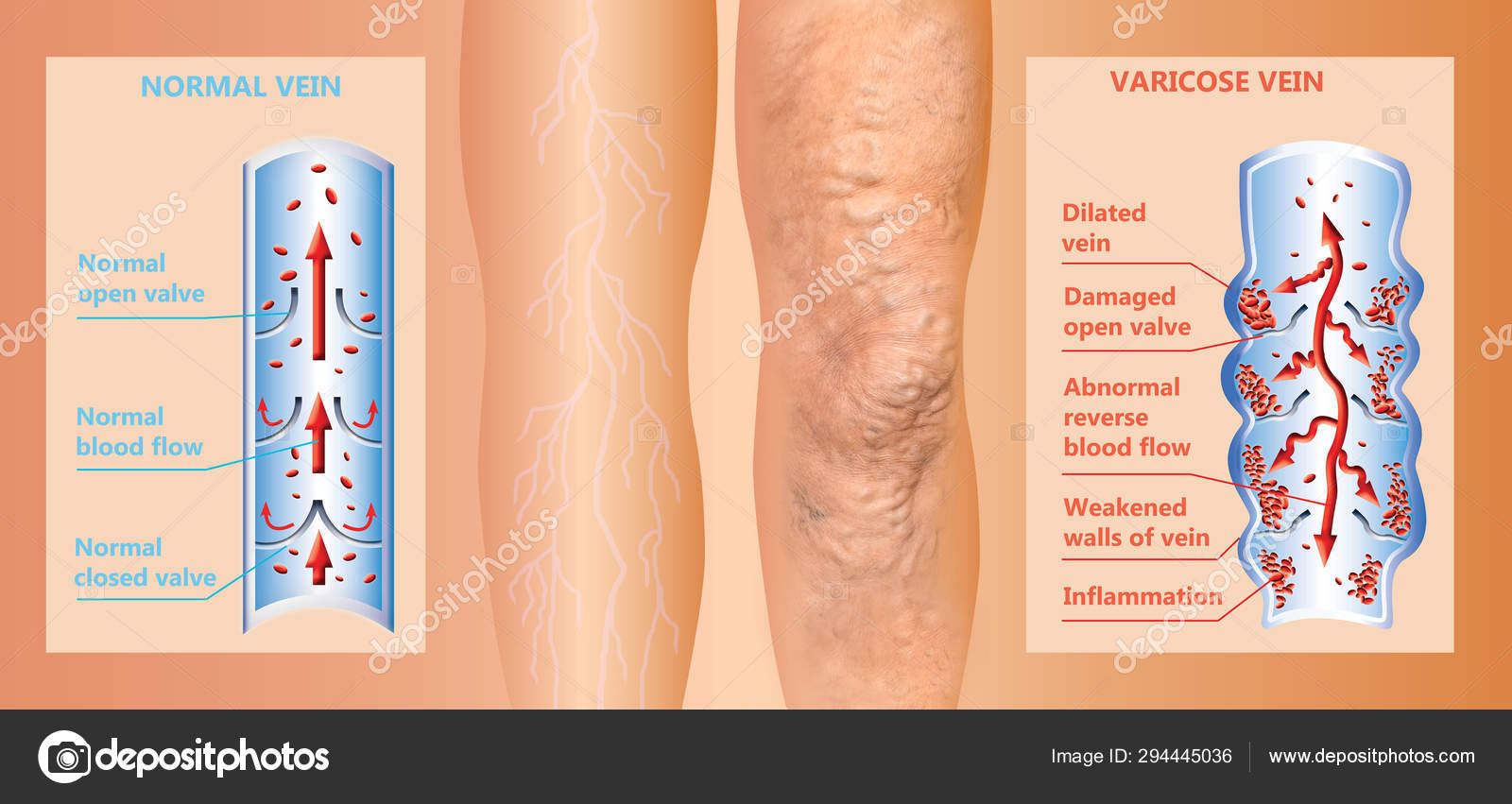 Varicose veins on a female senior legs. The structure of normal and varicose  veins. Stock Photo by ©Marina113 294445036