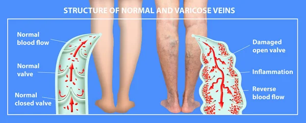 Varicose veins on a female senior legs. The structure of normal and varicose veins.