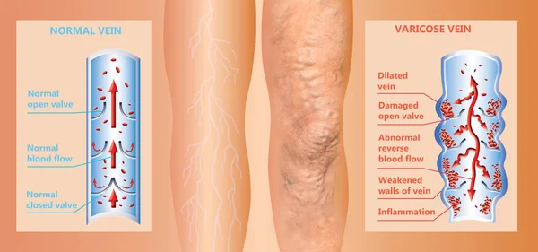 Варикозные вены на женских старших ногах. Структура нормальных и варикозных вен. — стоковое фото
