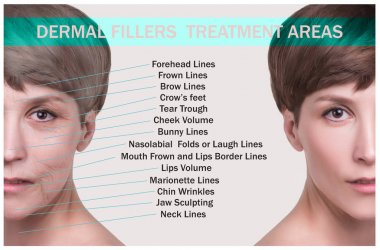 Kırışıklık önleyici enjeksiyon için tedavi alanları.