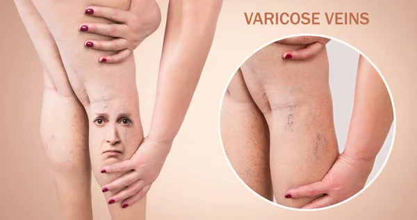 Legs with varicose veins — Stock Photo, Image