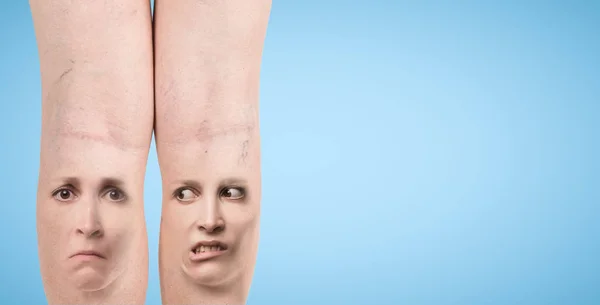 Ноги при варикозі — стокове фото