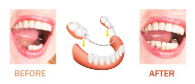 Dental rehabilitation with upper and lower prosthesis, before and after treatment clipart