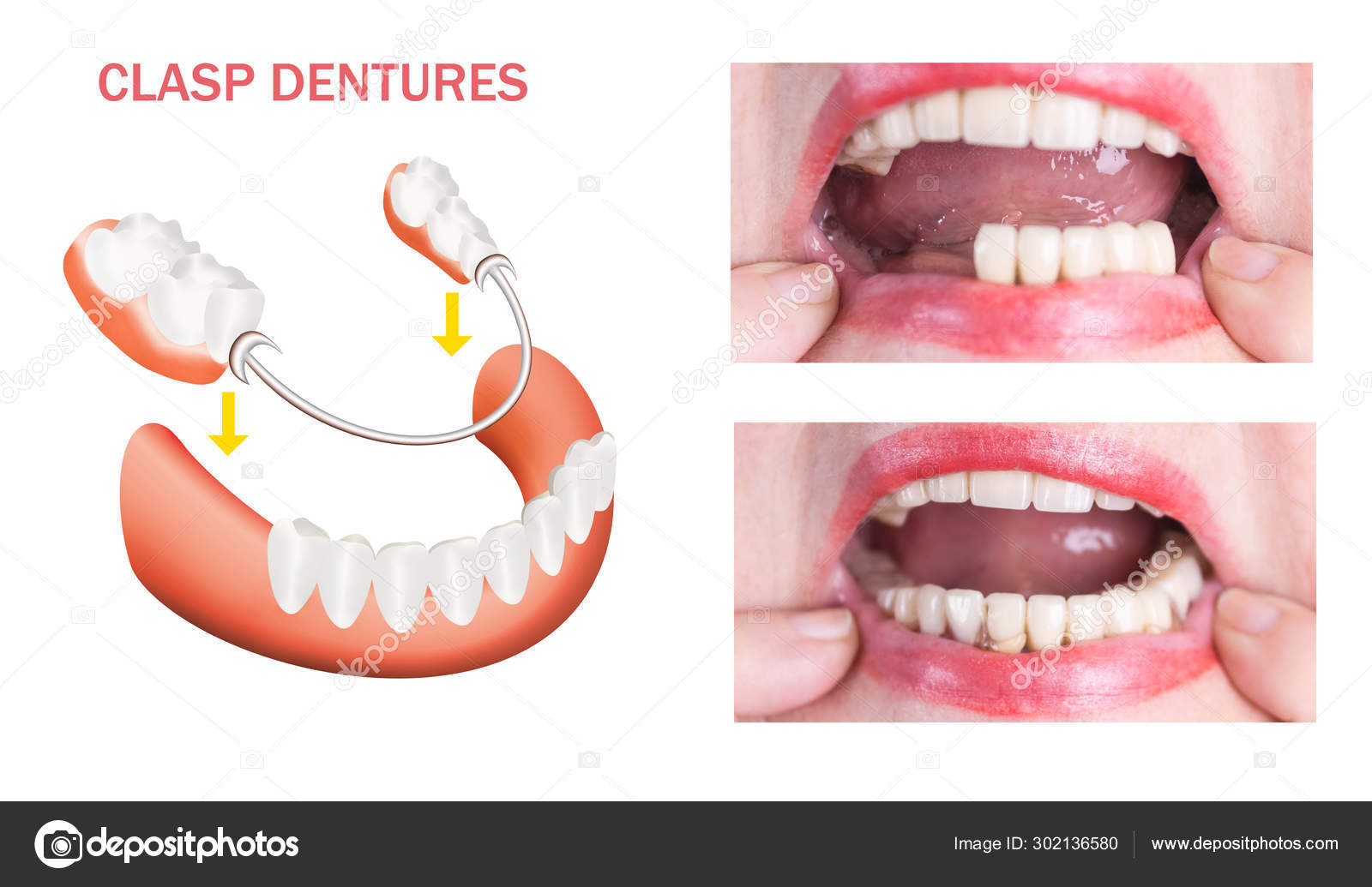 Dental rehabilitation with upper and lower prosthesis, before and after