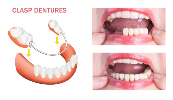 Rehabilitación dental con prótesis superior e inferior, antes y después del tratamiento —  Fotos de Stock