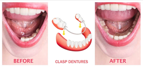 Rehabilitación dental con prótesis superior e inferior, antes y después del tratamiento —  Fotos de Stock