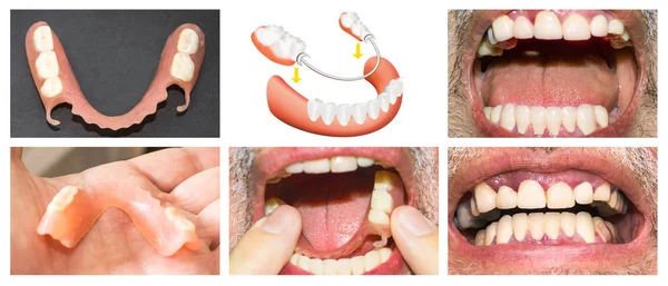 Reabilitação dentária com prótese superior e inferior, antes e após o tratamento — Fotografia de Stock