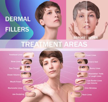 Kırışıklık önleyici iğne için tedavi alanları. Temiz ve taze ciltli genç bir kadın. Güzel kadın. Yüz ve boyun. Kafkasyalı genç bir modelin portresi. Kaldırma ve doldurma kavramı