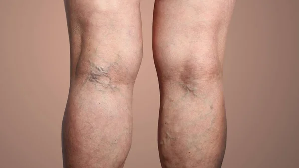 The old age and sick of a woman. Varicose veins on a legs of woman. The varicosity, spider veins, edema, illness concept.