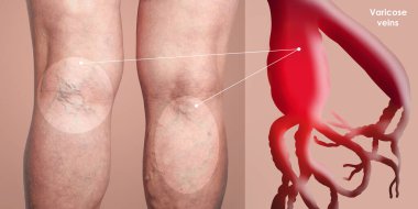 Yaşlılık ve bir kadından bıkmak. Bir kadının bacaklarındaki varis damarları. Varislik, örümcek damarları, ödem, hastalık konsepti..