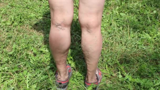 Das Alter Und Die Krankheit Einer Frau Krampfadern Den Beinen — Stockvideo