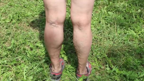 Yaşlılık Bir Kadından Bıkmak Bir Kadının Bacaklarındaki Varis Damarları Varislik — Stok video