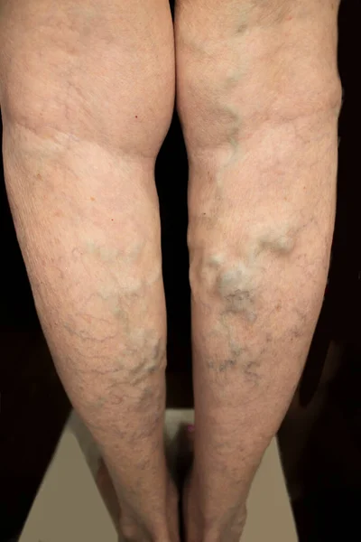 병들어 할머니의 다리에 정맥이 거미의 질병의 생활자 — 스톡 사진