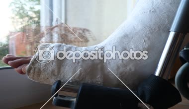 Hastanın hastanede kırık bacakla 