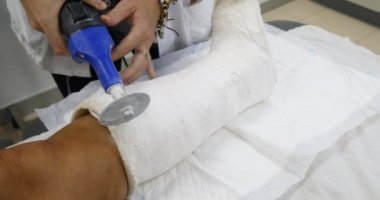 Doktor Hemşire sıva özel tıbbi ekipman ile kırık kemik bacak kaldırma  