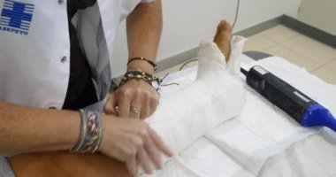 Doktor Hemşire sıva özel tıbbi ekipman ile kırık kemik bacak kaldırma  