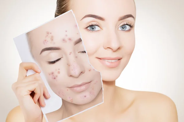 Πορτρέτο Closeup Της Γυναίκας Καθαρό Δέρμα Εκμετάλλευση Πορτρέτο Pimpled Δέρμα — Φωτογραφία Αρχείου