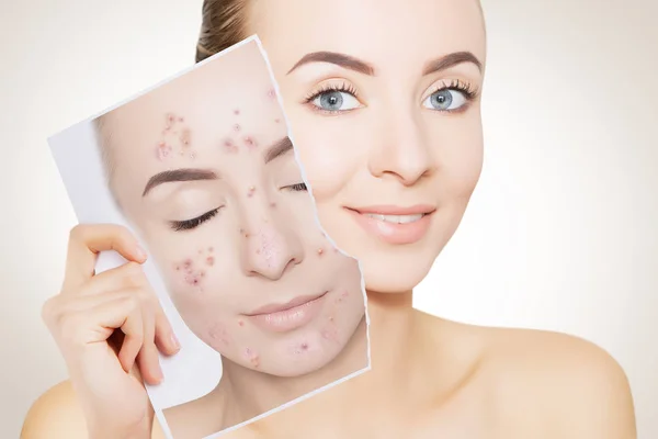 Closeup Portrait Woman Clean Skin Holding Portrait Pimpled Skin — Stock Photo, Image