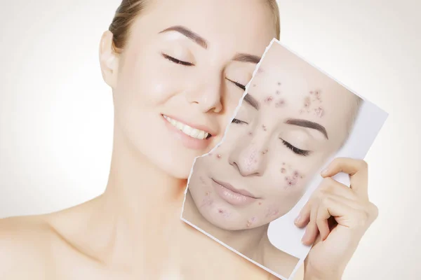 Closeup Portrait Woman Clean Skin Holding Portrait Pimpled Skin — Stock Photo, Image