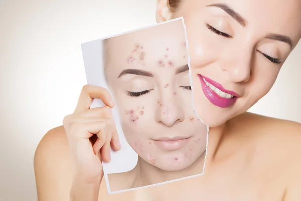 Closeup Portrait Woman Clean Skin Holding Portrait Pimpled Skin — Stock Photo, Image