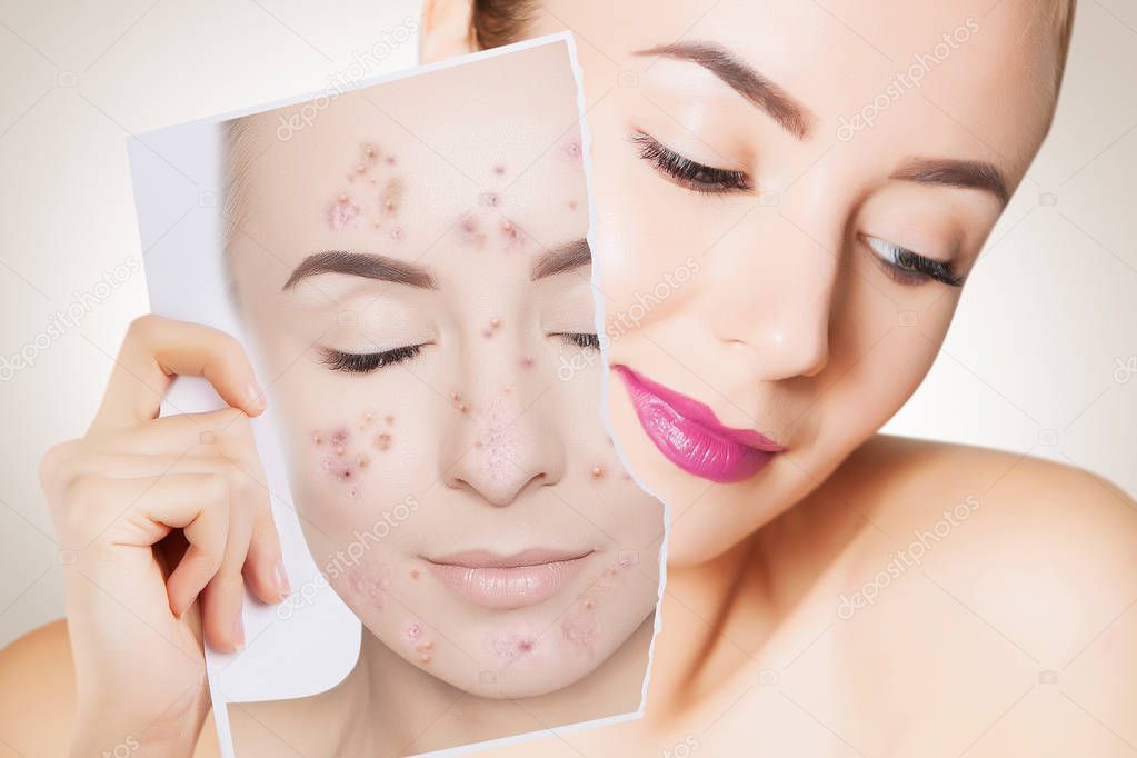 closeup portrait of woman with clean skin holding portrait with pimpled skin