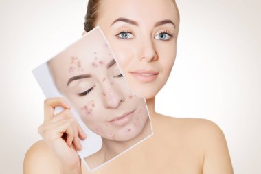 closeup portrait of woman with clean skin holding portrait with pimpled skin clipart