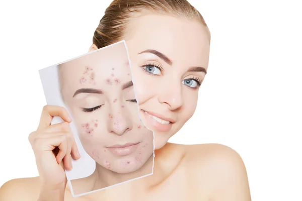 Closeup Portrait Woman Clean Skin Holding Portrait Pimpled Skin — Stock Photo, Image