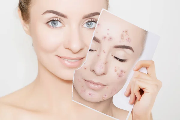 Closeup Portrait Woman Clean Skin Holding Portrait Pimpled Skin — Stock Photo, Image