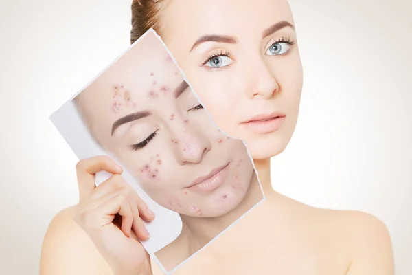 Closeup Portrait Woman Clean Skin Holding Portrait Pimpled Skin — Stock Photo, Image