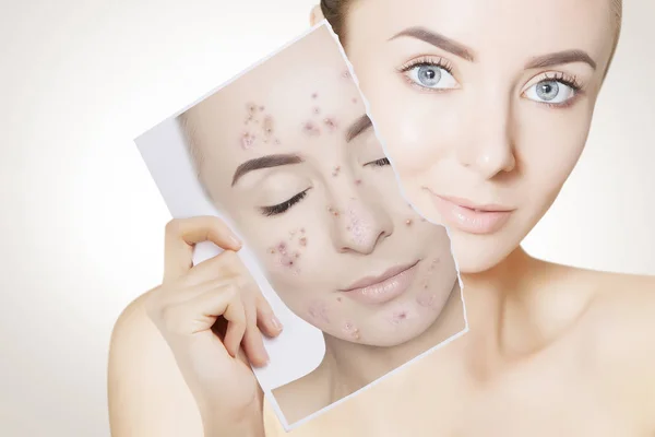 Πορτρέτο Closeup Της Γυναίκας Καθαρό Δέρμα Εκμετάλλευση Πορτρέτο Pimpled Δέρμα — Φωτογραφία Αρχείου