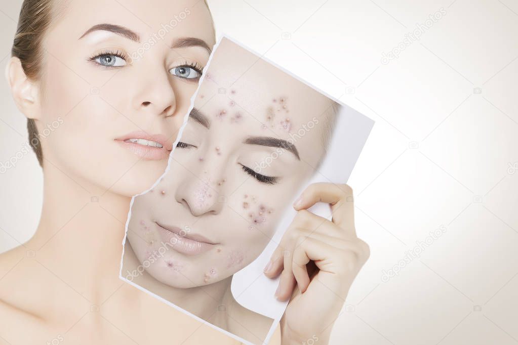 closeup portrait of woman with clean skin holding portrait with pimpled skin