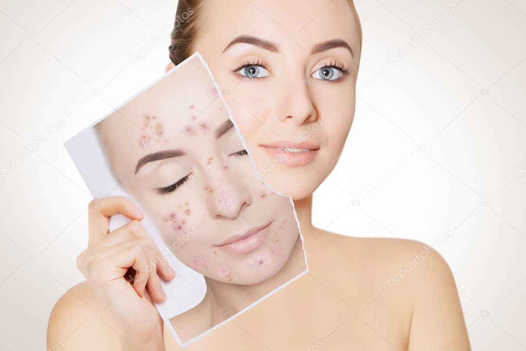 closeup portrait of woman with clean skin holding portrait with pimpled skin