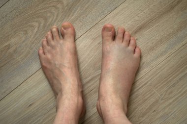 Şişmiş Ayağı Sağlıklı Ayağın yanında. Yaralı ve sağlıklı ayak karşılaştırması. Görünür şişlik, ahşap zeminde duruyor..