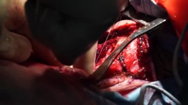 Birçok cerrahi sütürler