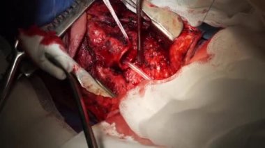 Trakea üzerinde nadir cerrahi