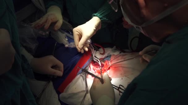 Рідкісна хірургія на трахеї — стокове відео