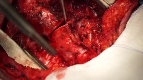 Sällsynt kirurgi på luftstrupen — Stockvideo