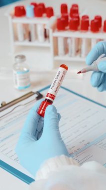Doktorun dikey videosu, el laboratuarında prostat için kan testi tüpü tutuyor.