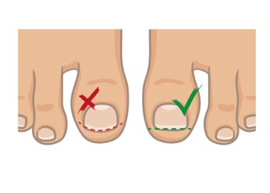 How to cut toenails, right and wrong concept. How to avoide ingrown nail. Female or male foot sole, barefoot, top view. Vector illustration, hand drawn cartoon style isolated on white. clipart