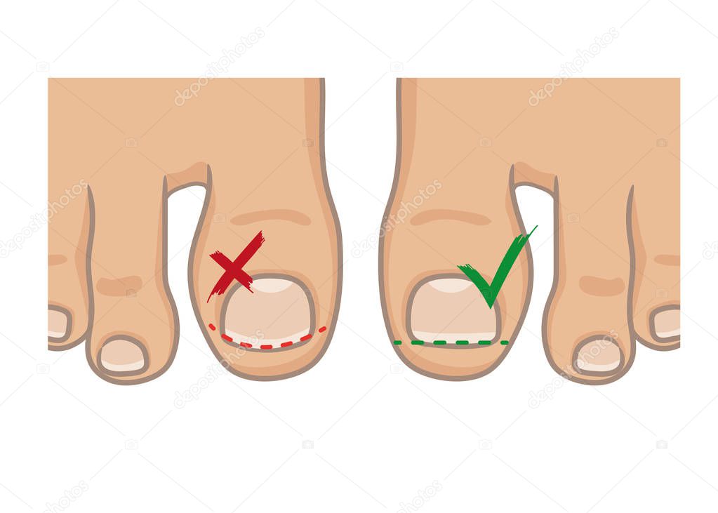 How to cut toenails, right and wrong concept. How to avoide ingrown nail. Female or male foot sole, barefoot, top view. Vector illustration, hand drawn cartoon style isolated on white.