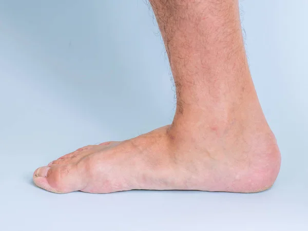 Bir Adam Sağ Bacak Eklem Hastalığı Düz Ayak Izi Ile — Stok fotoğraf