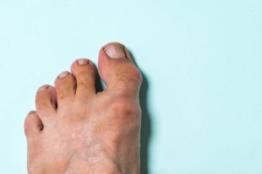 Deri hastalığı belirtileri olan bir adamın sol bacağı..