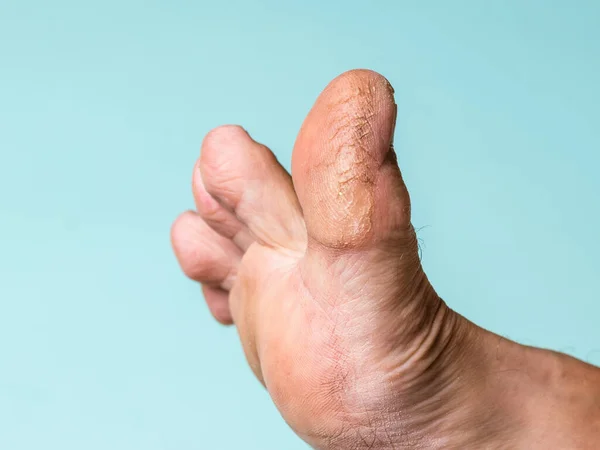 El dedo gordo del pie izquierdo de un hombre con signos de enfermedades de la piel . — Foto de Stock