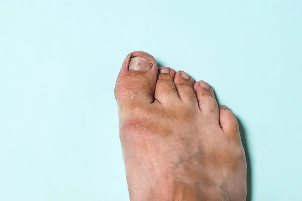 La pierna derecha de un hombre sobre un fondo azul con signos de enfermedades fúngicas de la piel . — Foto de Stock