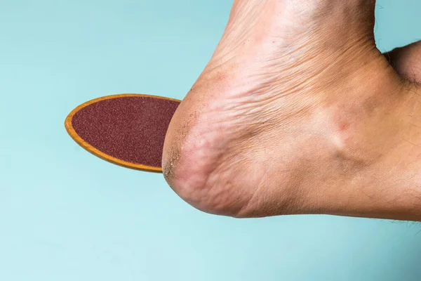 Tratamiento de la piel áspera en el talón del pie de un hombre. — Foto de Stock