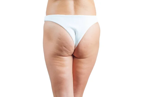 Natiche Femminili Con Cellulite Pelle Cellulite Natiche Donna — Foto Stock