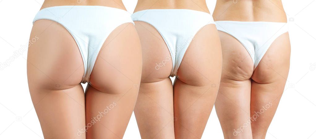 Female buttocks before and after anti cellulite treatment. Plastic surgery concept