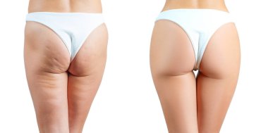 Kadın kalça anti selülit masaj işlemden önce ve sonra. Plastik cerrahi kavramı
